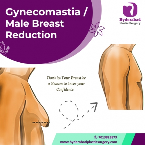 Gynecomastia insta poster1 copy.jpg